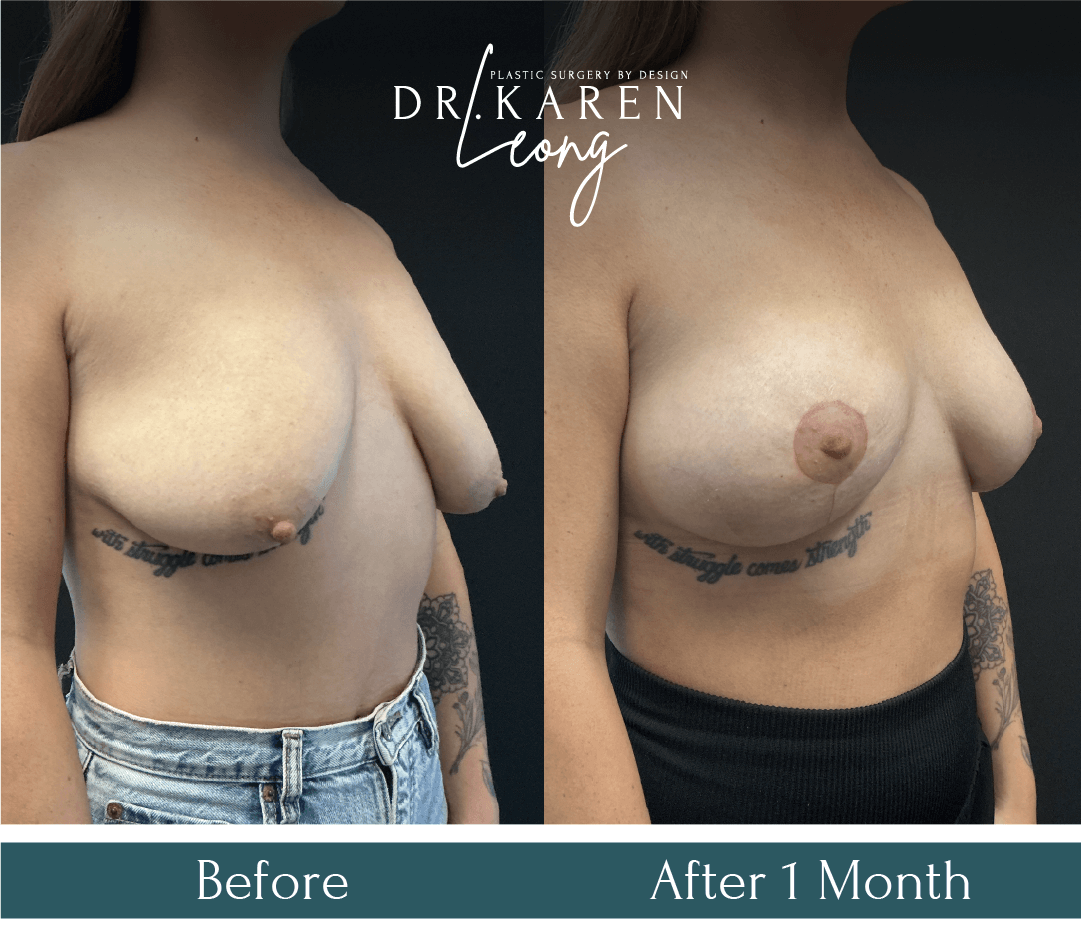 Dr Karen Leong Before After Dec 25 - Breast Lift