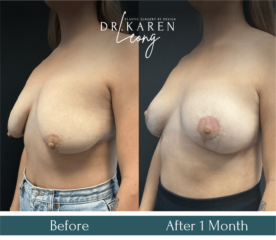Dr Karen Leong Before After Dec 25 - Breast Lift