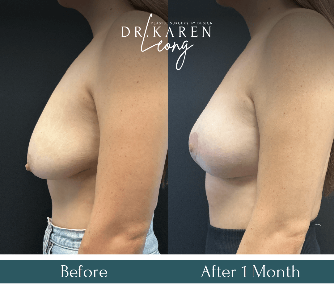 Dr Karen Leong Before After Dec 25 - Breast Lift