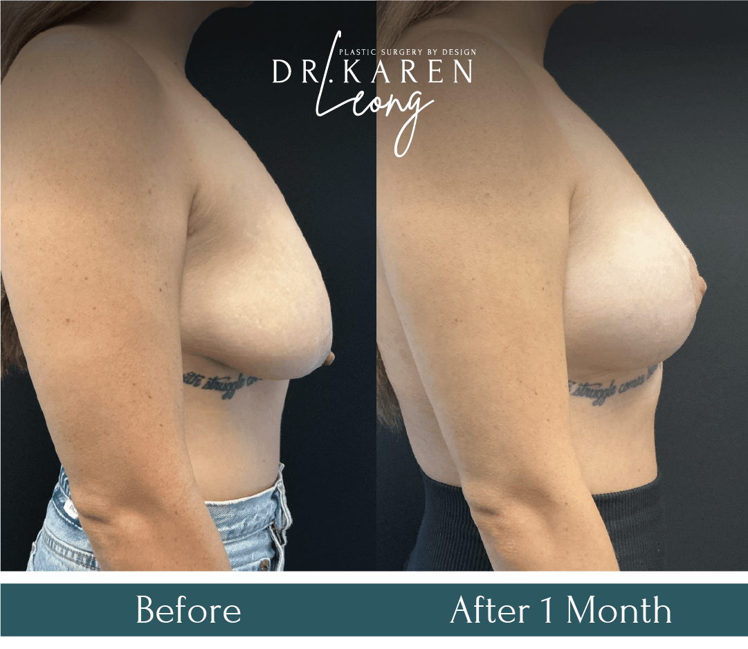 Dr Karen Leong Before After Dec 25 - Breast Lift