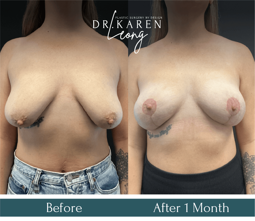 Dr Karen Leong Before After Dec 25 - Breast Lift