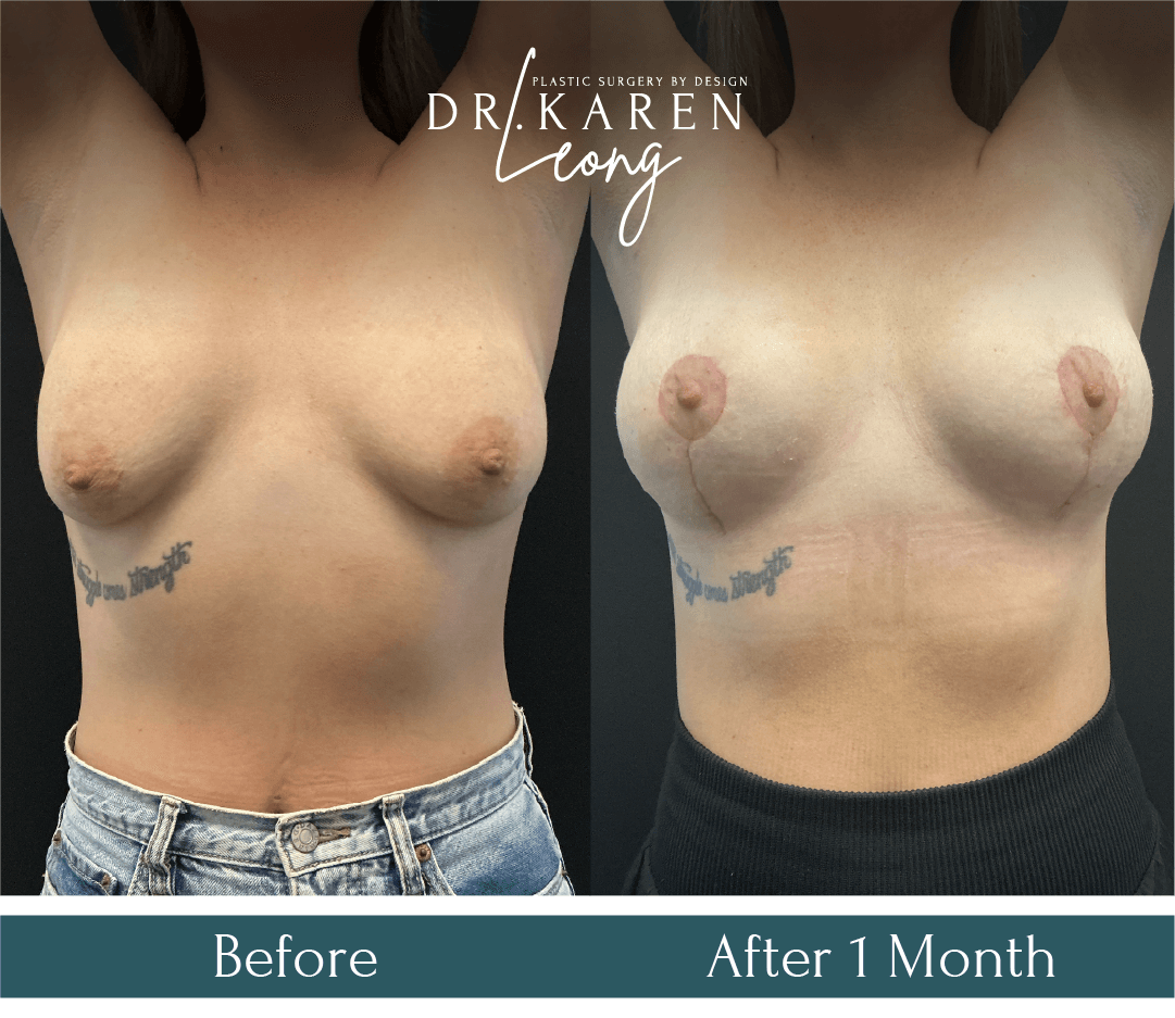 Dr Karen Leong Before After Dec 25 - Breast Lift