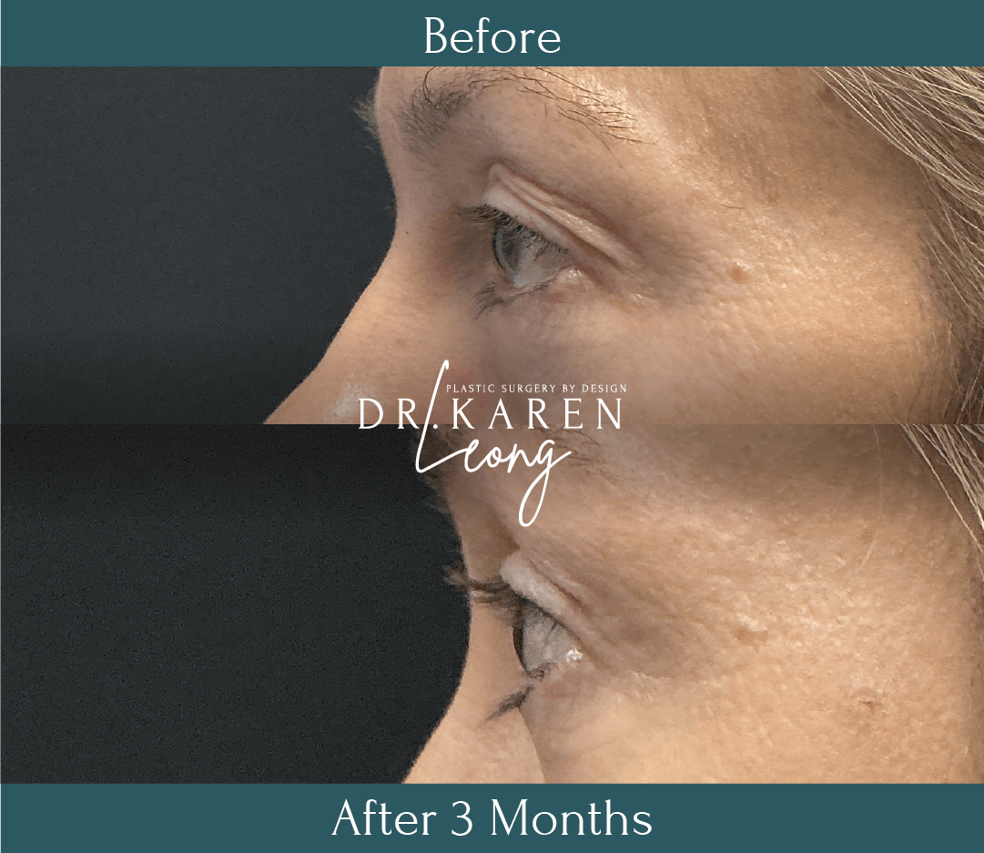 Dr Karen Leong Before After Dec 25 - Eyelid Lift