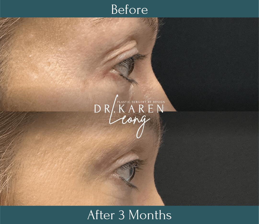 Dr Karen Leong Before After Dec 25 - Eyelid Lift