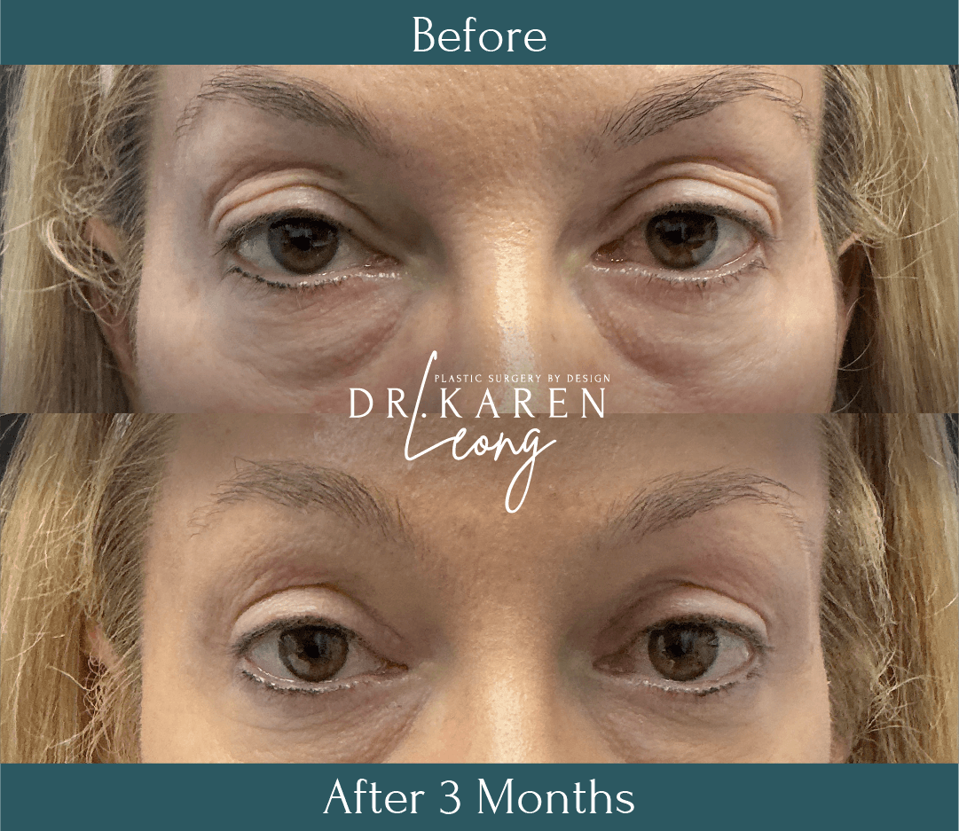Dr Karen Leong Before After Dec 25 - Eyelid Lift
