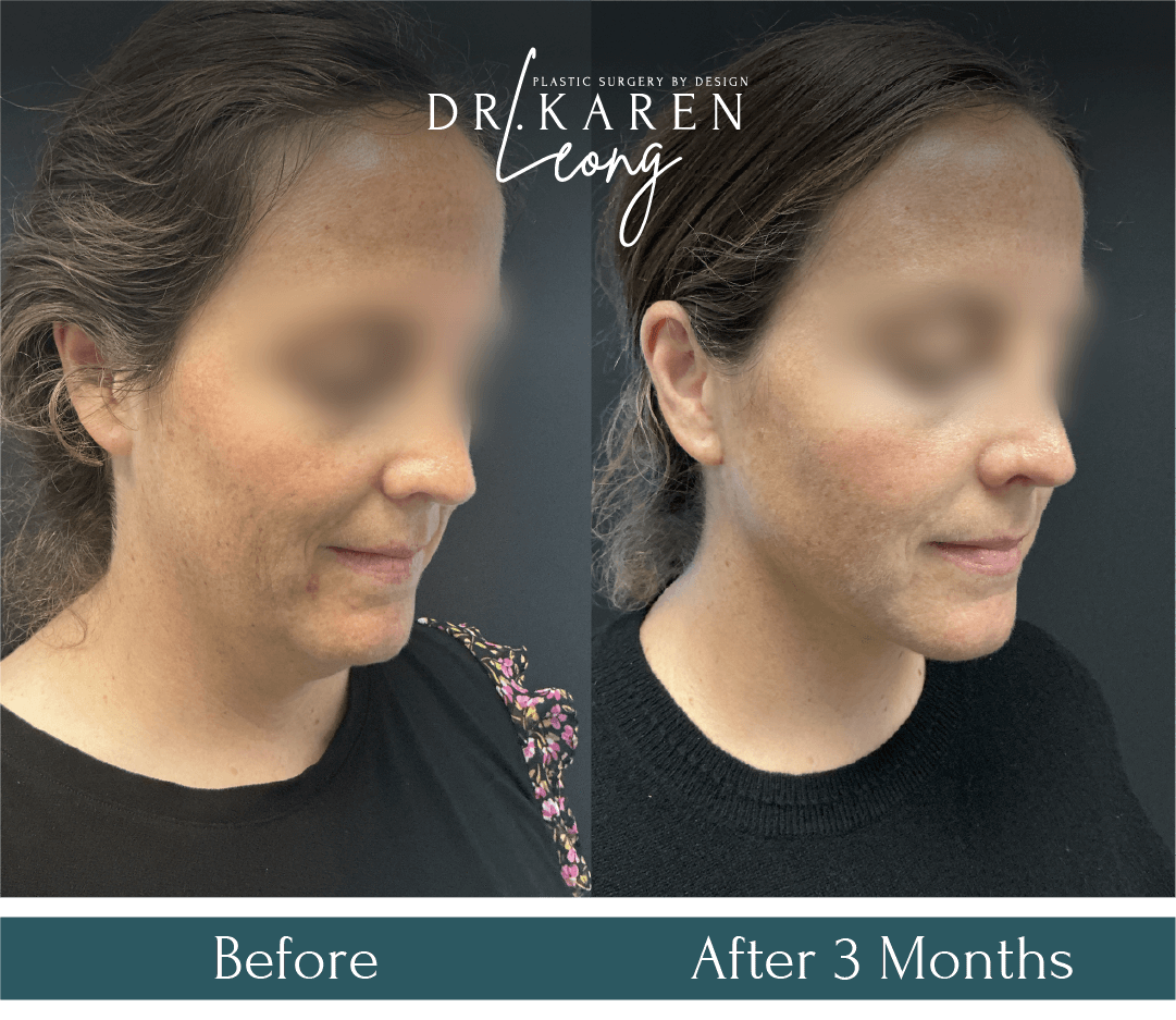Dr Karen Leong Before After Dec 25 - Face Neck Lift