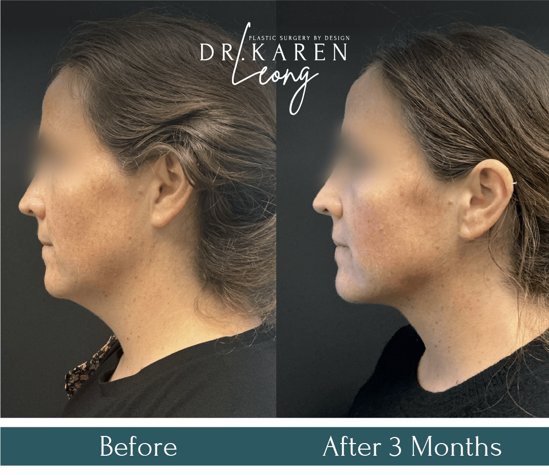 Dr Karen Leong Before After Dec 25 - Face Neck Lift