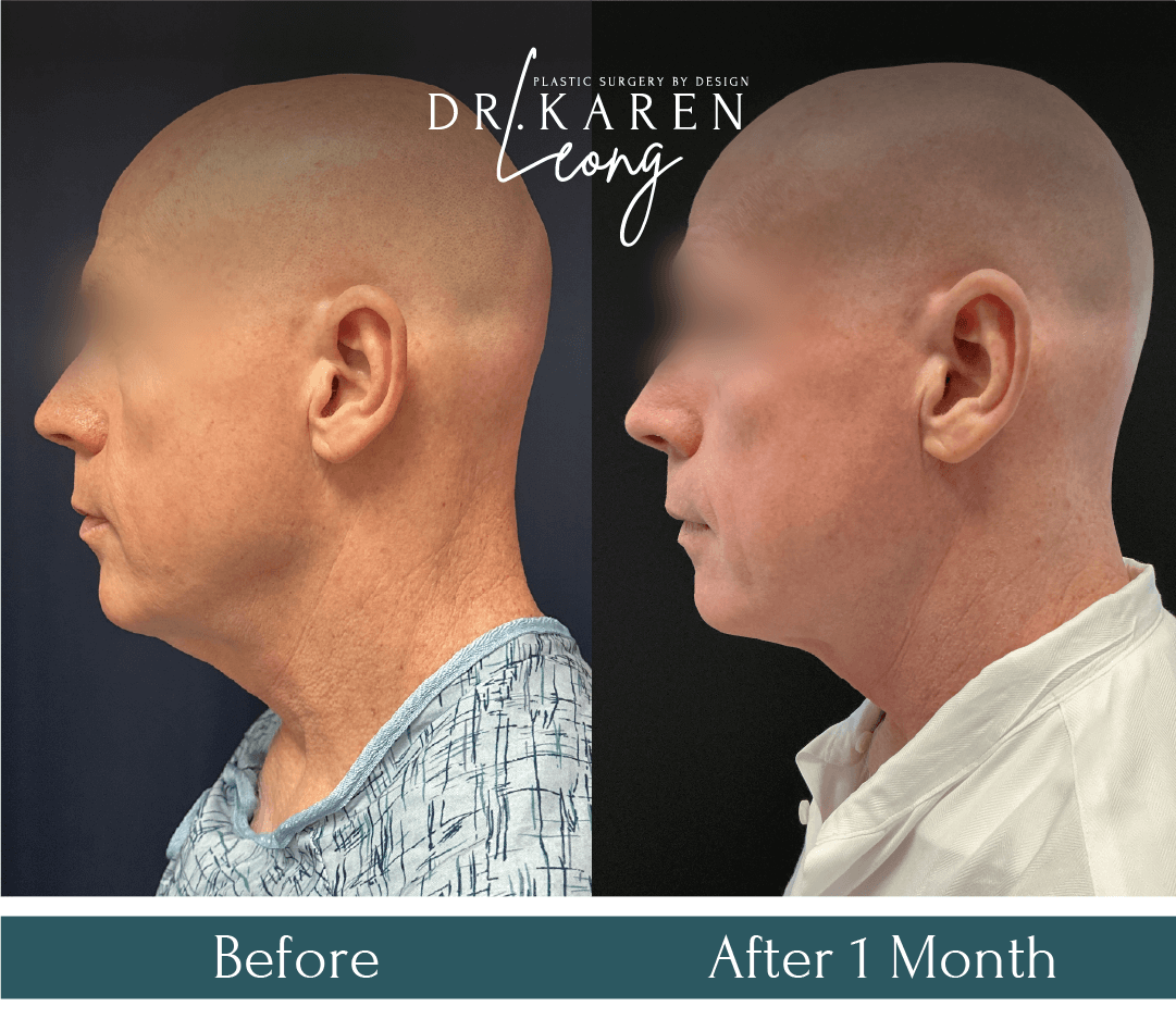 Dr Karen Leong Before After Dec 25 - Face Neck Lift