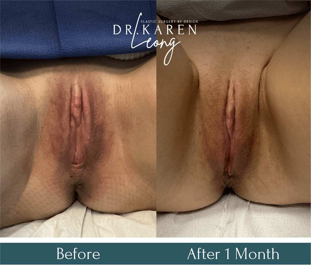 Dr Karen Leong Before After Dec 25 - Labiaplasty
