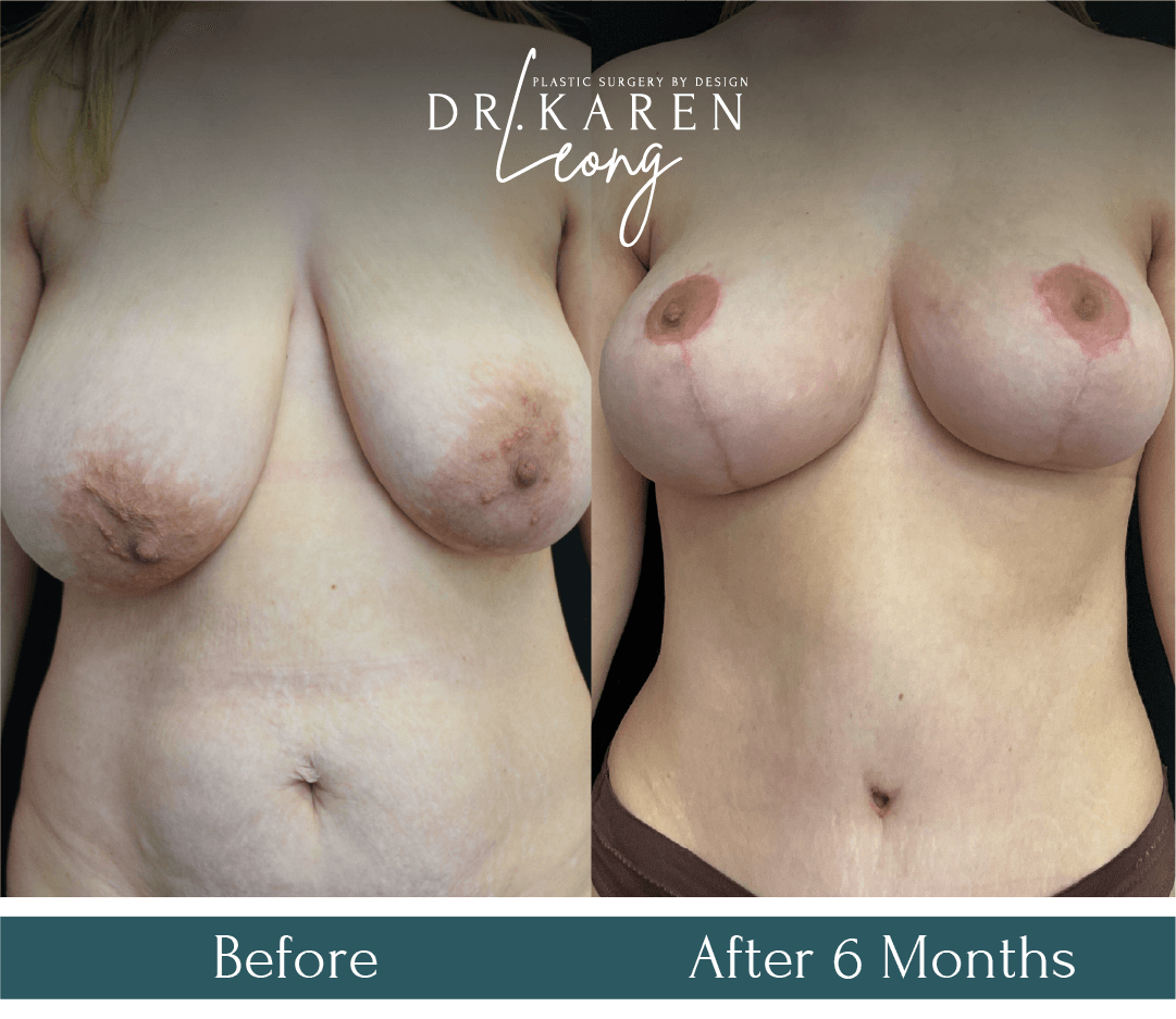 Dr Karen Leong Before After - Breast Reduction