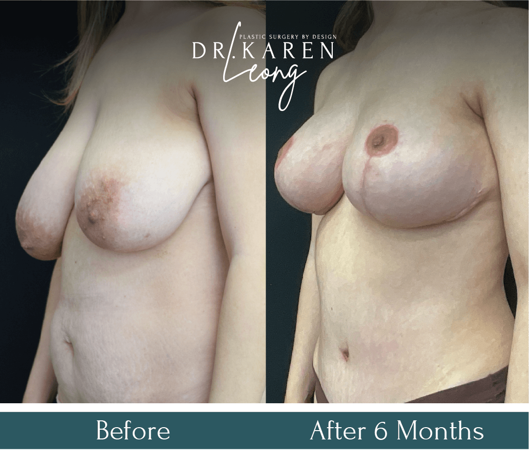 Dr Karen Leong Before After - Breast Reduction