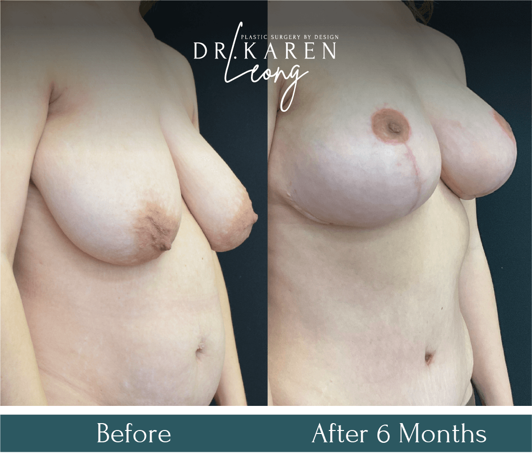 Dr Karen Leong Before After - Breast Reduction