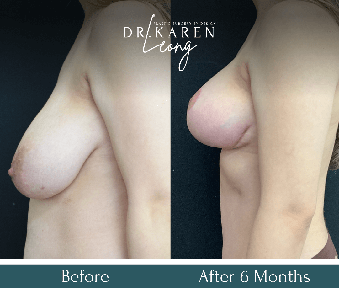 Dr Karen Leong Before After - Breast Reduction