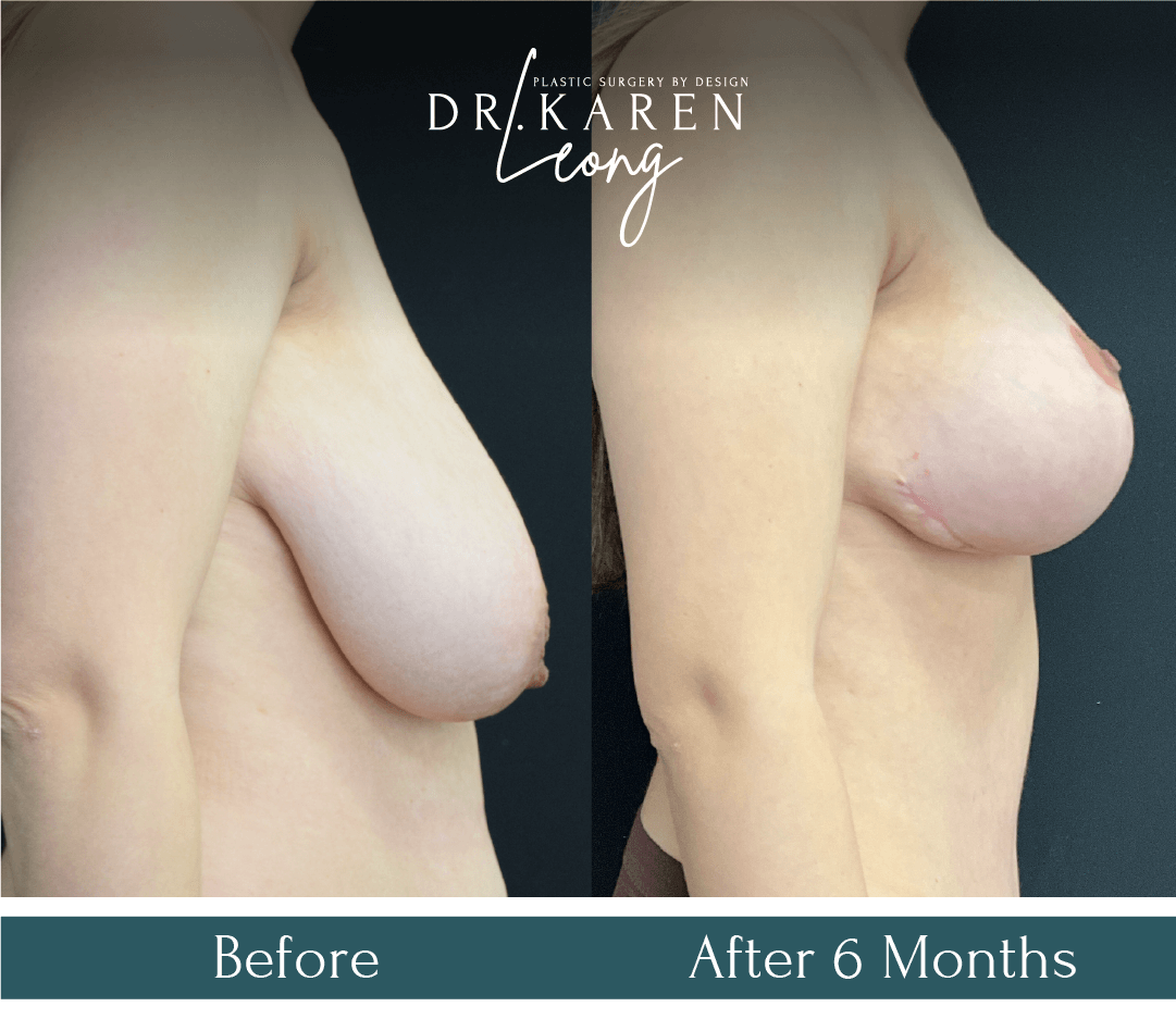 Dr Karen Leong Before After - Breast Reduction