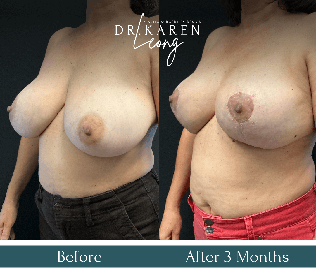 Dr Karen Leong Before After - Breast Reduction