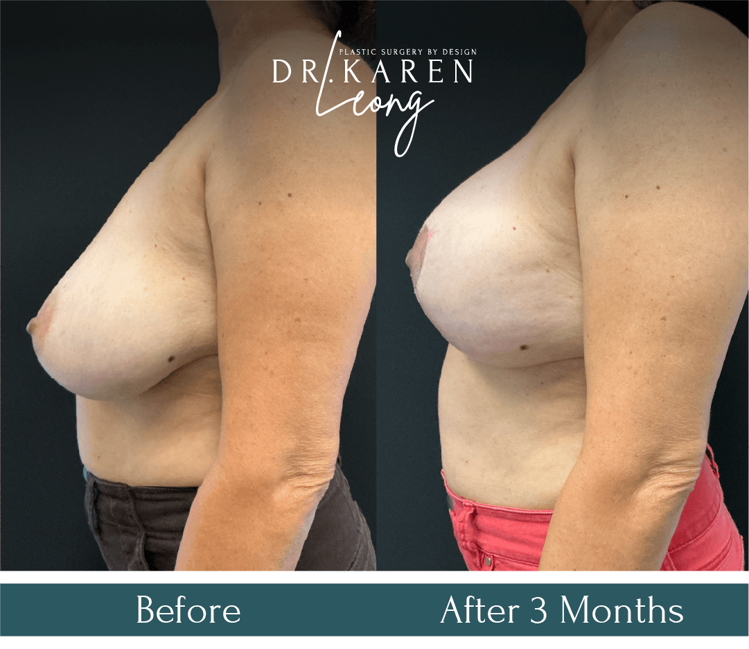 Dr Karen Leong Before After - Breast Reduction