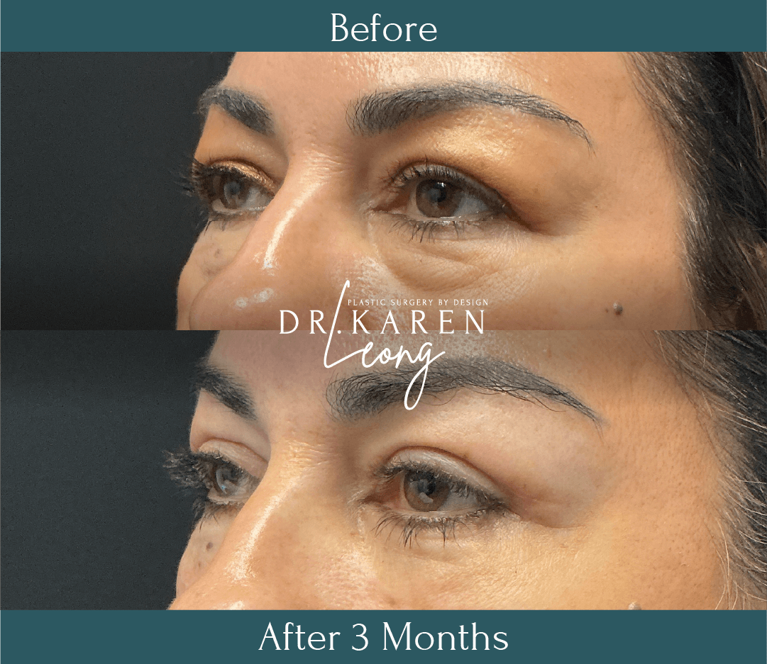 Dr Karen Leong Before After Feb 26 - Eyelid Lift