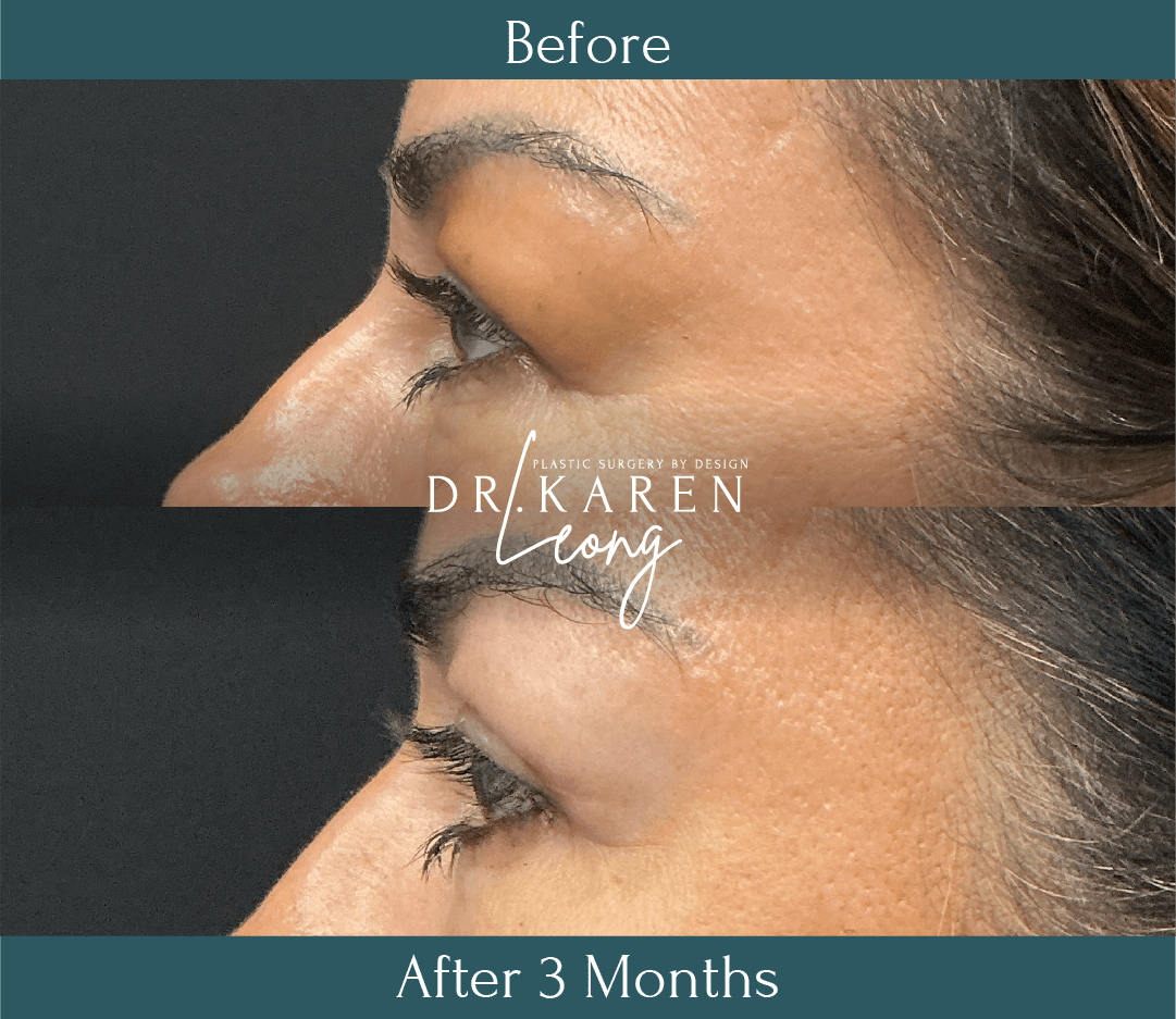 Dr Karen Leong Before After Feb 26 - Eyelid Lift