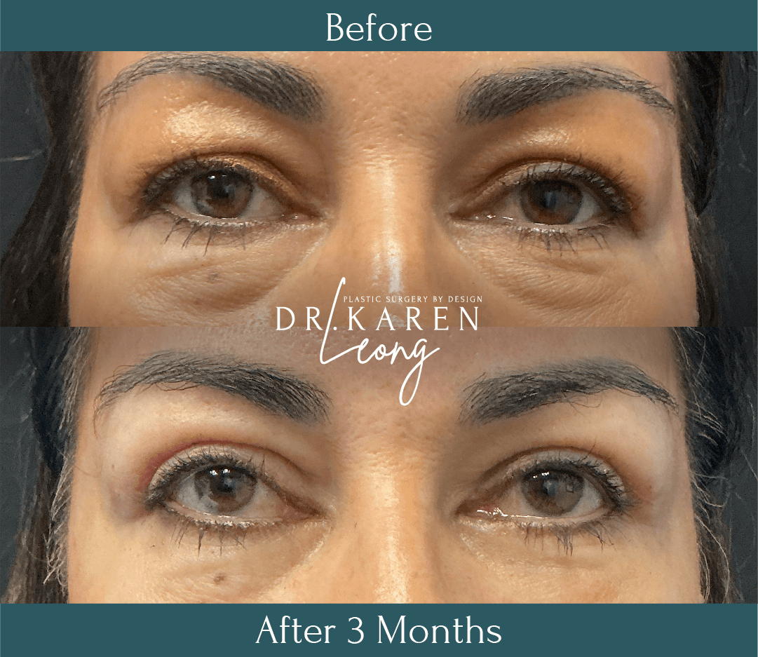 Dr Karen Leong Before After Feb 26 - Eyelid Lift