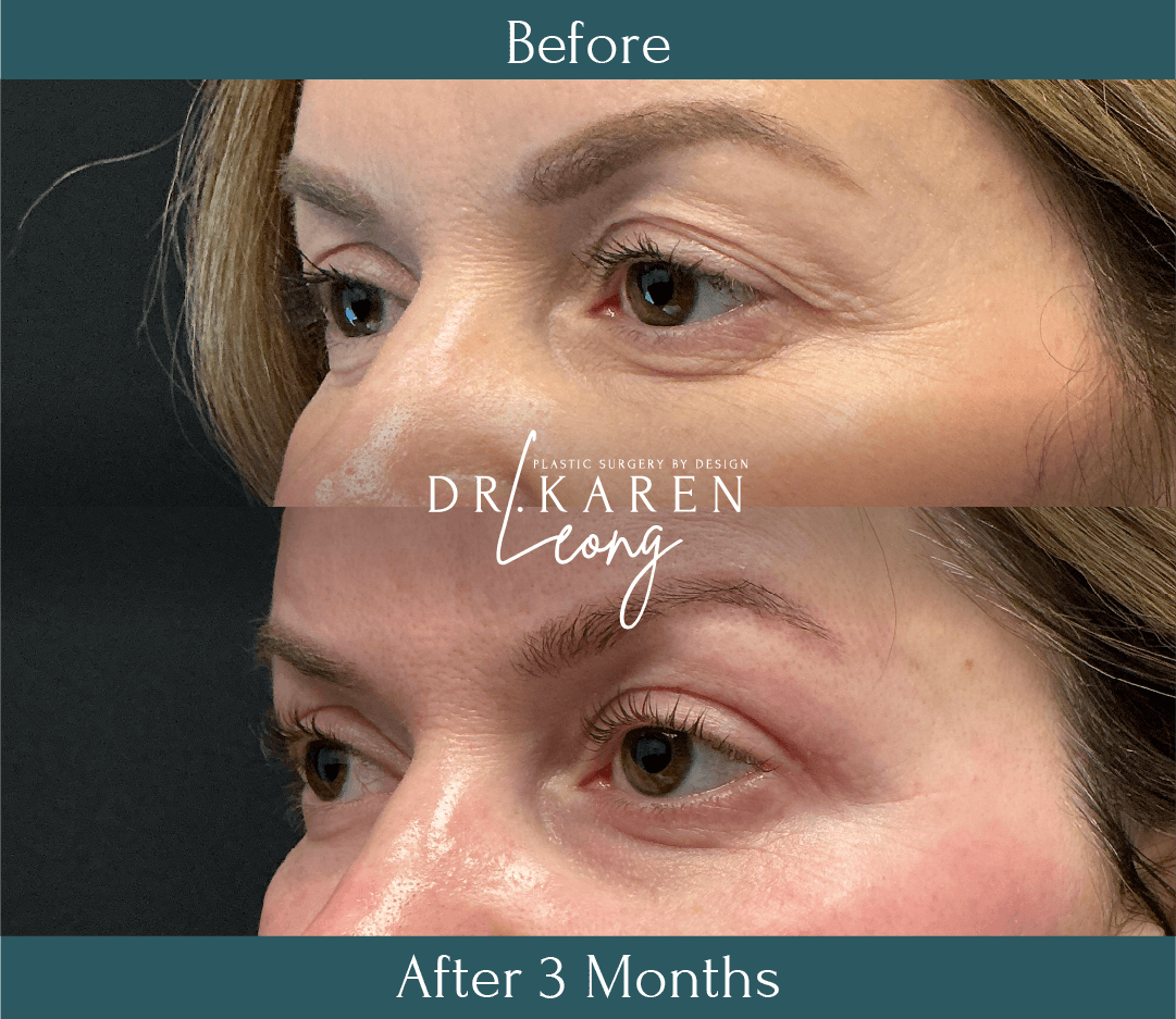 Dr Karen Leong Before After Feb 26 - Eyelid Lift