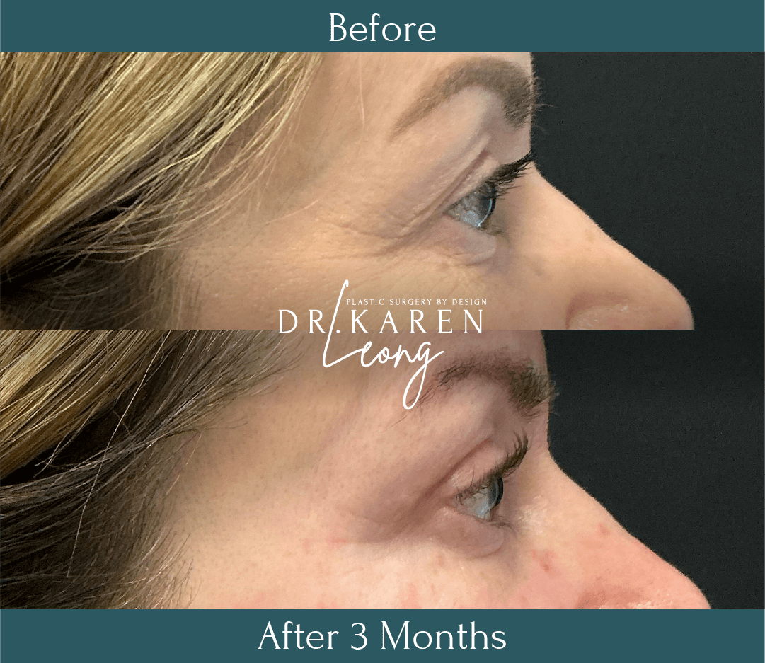 Dr Karen Leong Before After Feb 26 - Eyelid Lift