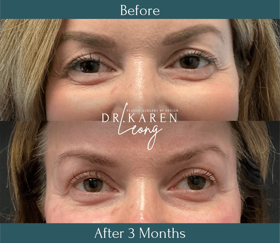 Dr Karen Leong Before After Feb 26 - Eyelid Lift