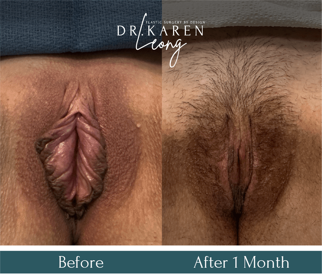 Dr Karen Leong Before After Feb 26 - Labiaplasty